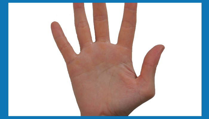 Basal Thumb Arthritis التهاب مفصل الإبهام