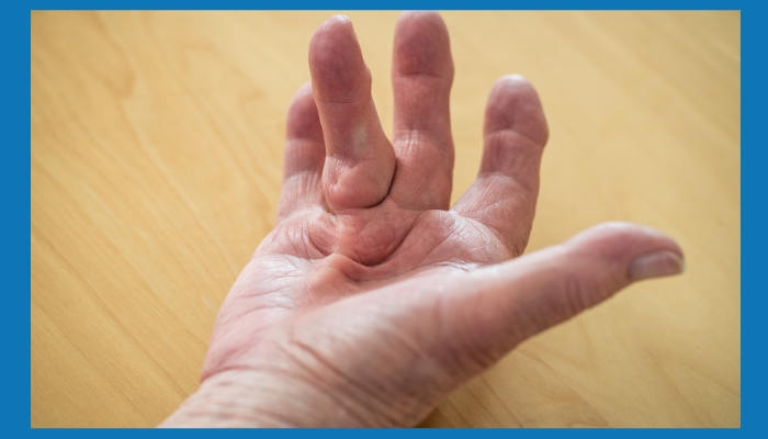 Dupuytren Disease