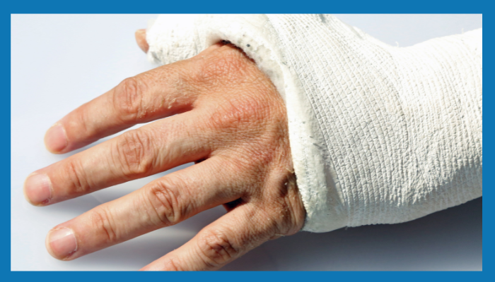 Hand Fractures