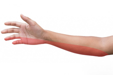Cubital Tunnel Syndrome 1