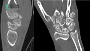Scaphoid fracture