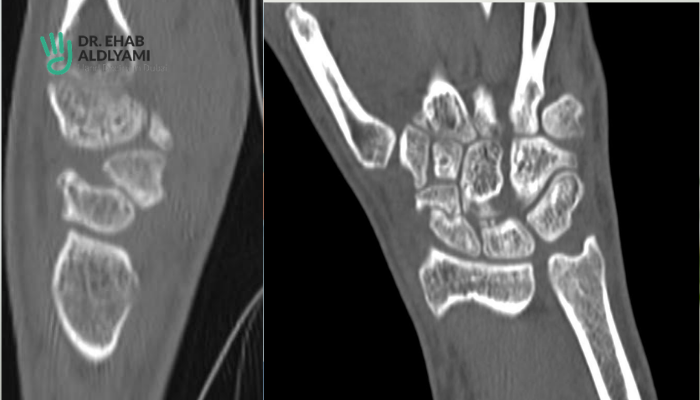 Scaphoid fracture