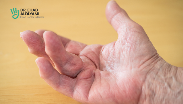 Pain in the Fingers: Understanding Causes and Effective Treatments 4 dupuytrens disease