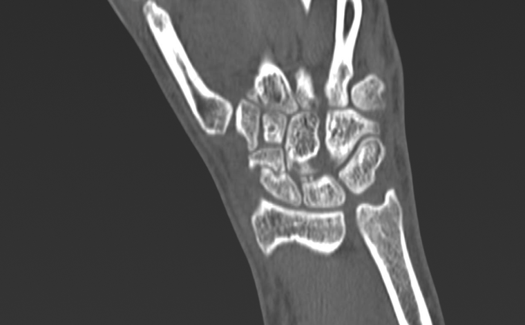 Scaphoid fracture 2