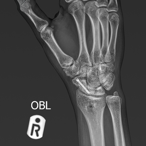 Surgical option for Scaphoid