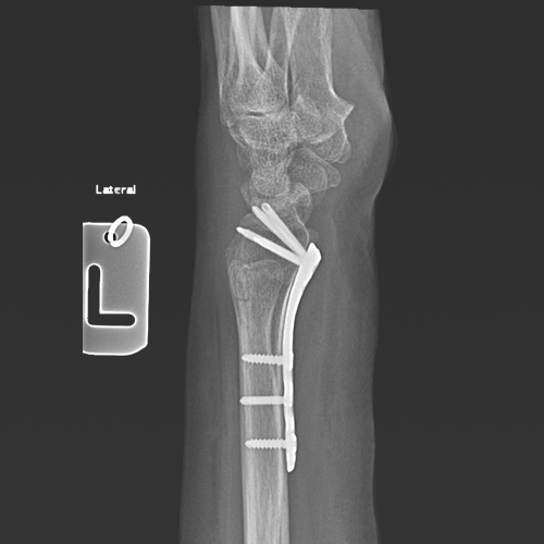surgical-option-for-Distal-fracture-2.png