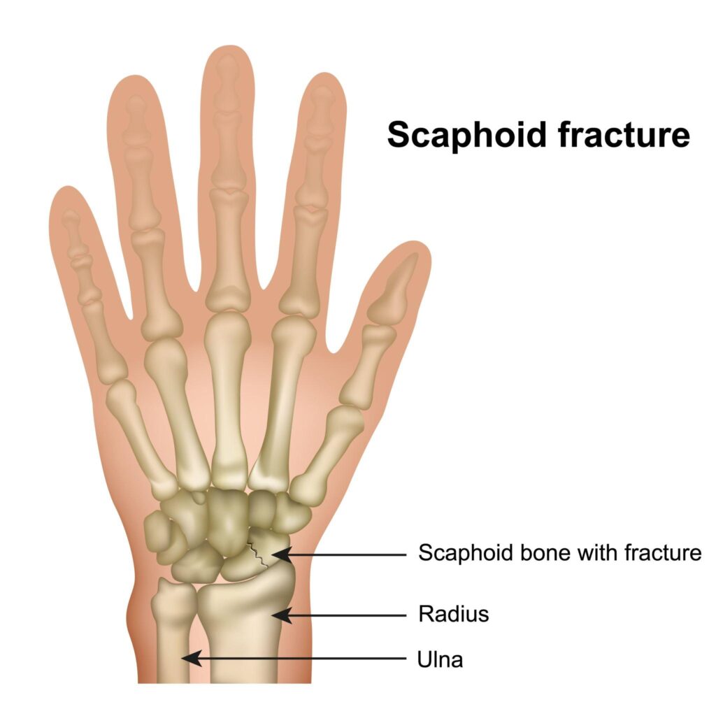Scaphoid bone in hand
