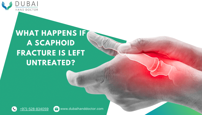 What happens if a scaphoid fracture is left untreated?