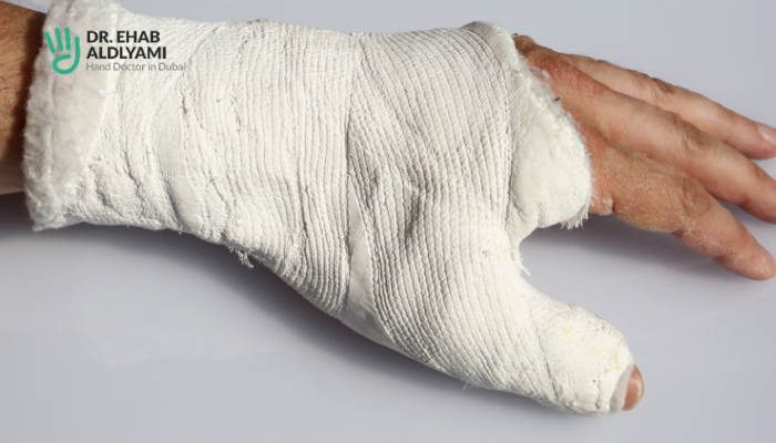 Broken hand - Diagnosis & Treatment