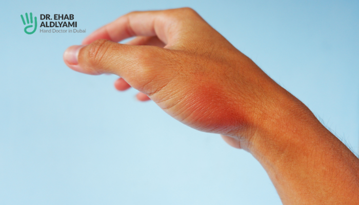 gamers hand syndrome