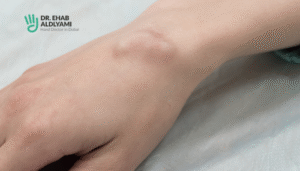Spotting Dupuytren’s Disease: Nodules, Cords, and When to See a Specialist 16 wrist ganglions