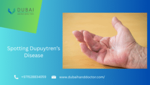 dupuytren's disease