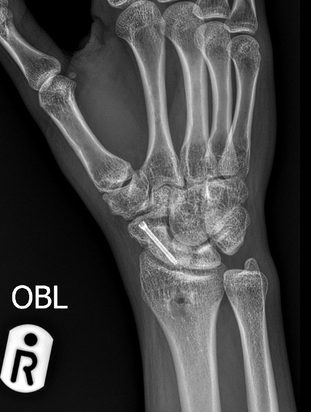 Scaphoid fracture 1 كسر العظم الزورقي