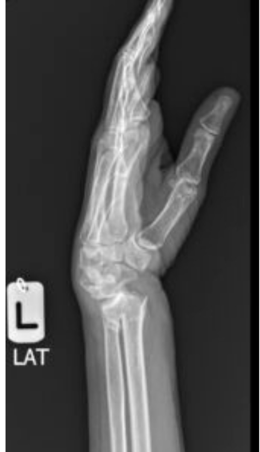 كسر عظمة الكعبرة 3 Xray hand 1 167 x 290
