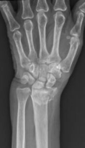 Xray hand 2 167 x 290 px