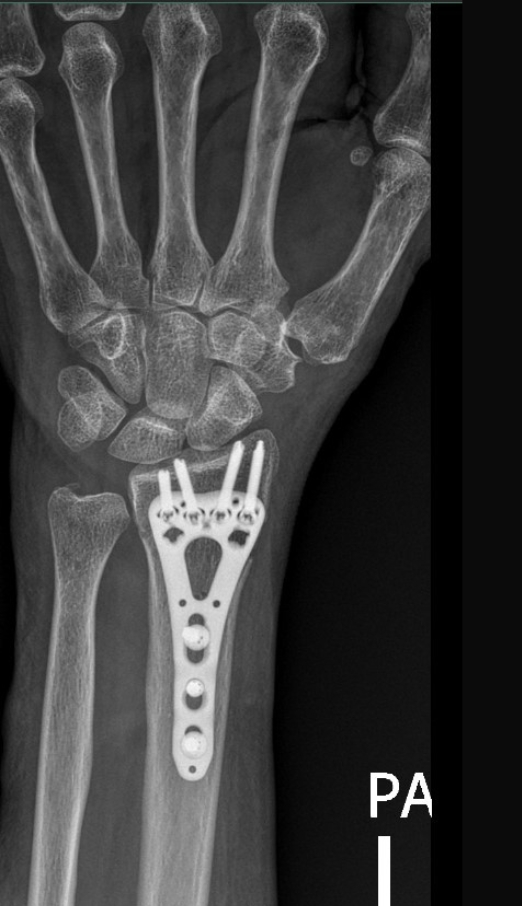كسر عظمة الكعبرة 4 Xray hand 3 167 x 290