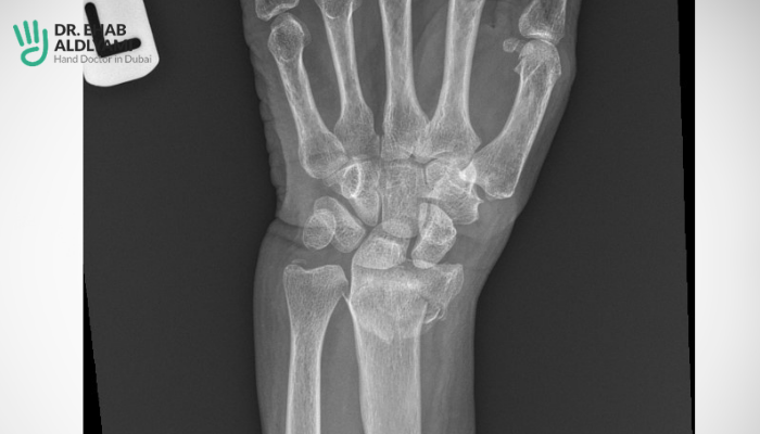 Distal radius fracture