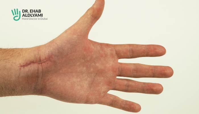 What Does It Feel Like When Your Scaphoid Is Broken