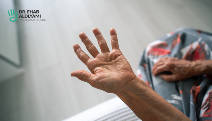 Does Dupuytren’s Contracture Get Worse Over Time