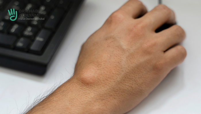 Common Symptoms of Ganglion Cysts You Shouldn’t Ignore