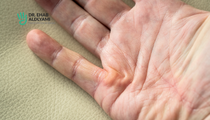 Dupuytren Contracture: Treatment & management