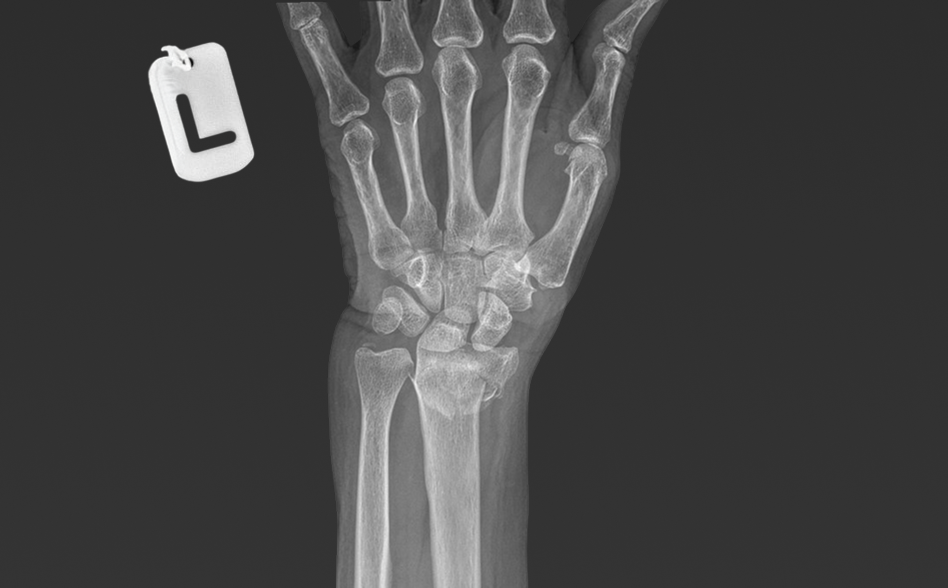 Distal radius Fracture Treatment in Dubai