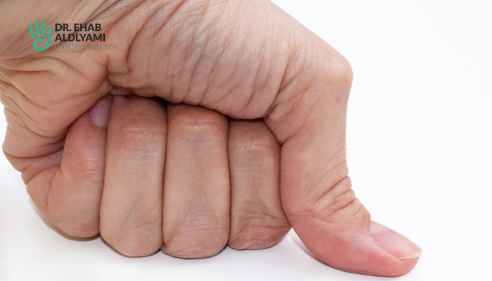 Thumb joint replacement: What it is, symptoms and treatment?