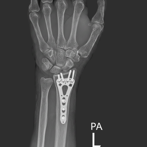 surgical option for Distal fracture -1