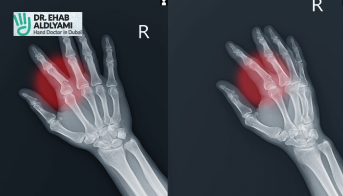 Common Scaphoid Fracture Complications