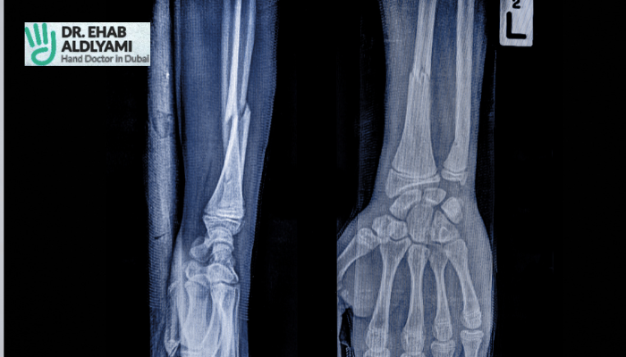 Postoperative Protocol for Distal Radius Fractures