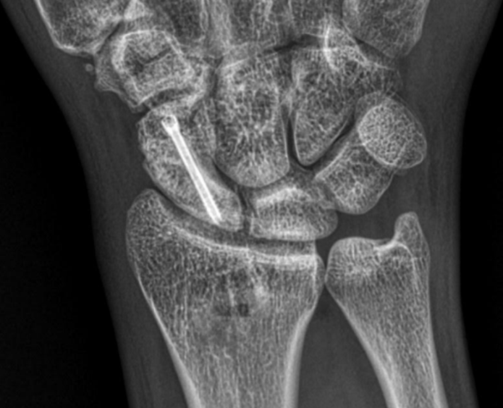 Scaphoid canva Scaphoid fracture treatment in dubai